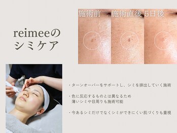 レイミー(reimee)/【シミケア】施術の様子・経過