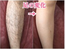 ディオーネ 上越南高田店(Dione)の雰囲気（女性20代の方/剛毛さんでも大丈夫!埋没毛・剃り跡のない美肌に♪）