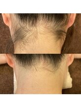 アイビー(IVY)/うなじ脱毛