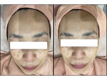 リッツ 所沢店/【Before/After】シミ改善