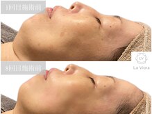 ラヴィオーラ 明石店(La Viora)/ダイヤモンドハーブピーリング