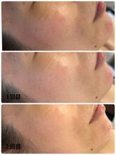 リム ビューティー(RYM BEAUTY)/ダクトピールはお顔の赤みにも♪