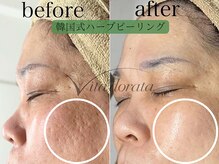 ヴィータドラータ(Vita dorata)の雰囲気（【真皮から若返る!?】ハーブピーリング◎痕/毛穴/色素/シミ/シワ）
