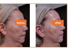 アフロディーテ北山/二重アゴ改善