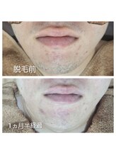 アカラ 読谷店(AKALA)/ヒゲ脱毛１か月半経過【５回目】