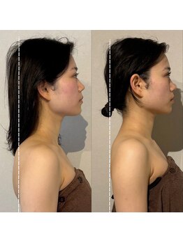 ミライ小顔 名古屋店(MIRAI小顔)/MIRAI小顔 ◆姿勢改善◆