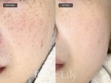 ブランリリー 福岡薬院店(Blanc Lily)の雰囲気（経験人数、症例が信頼の証。実績4,800名以上肌を見てきました）