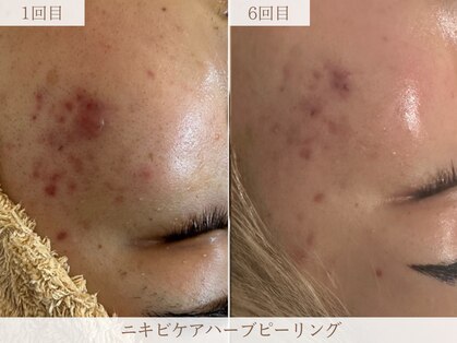 ミモザ(MIMOSA)の写真