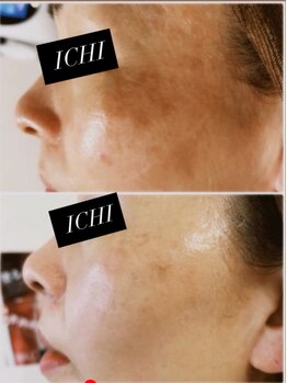 イチ(ICHI)/ホワイトラボ