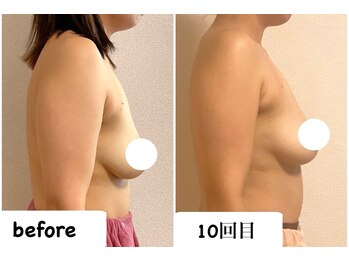 つばききよら/授乳で下がったバストがお悩みで