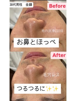 エミナル(EMINARU)/毛穴洗浄