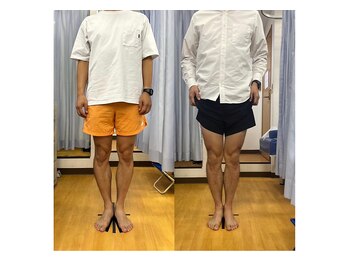 キュア整骨院(CURE整骨院)/Ｏ脚矯正コース実績６