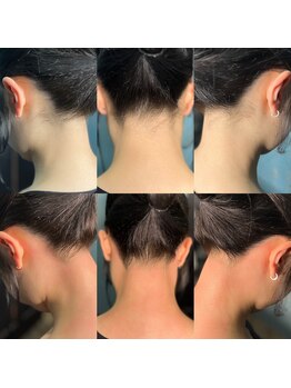 シュシュ 梅田店(+Chou chou)/うなじ脱毛