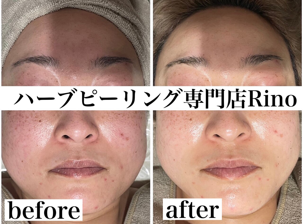 ハーブピーリング 初めてのハーブピーリングお試し頂きました🌿 ⁡ ニキビ跡がお悩みで