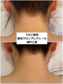 プレヴェール 神戸三宮/うなじ脱毛