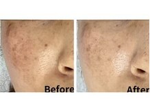 ラエッセ 目黒 白金台店(LAESSE)/毛穴・美白専門店 LAESSE 白金台