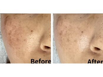 ラエッセ 目黒 白金台店(LAESSE)/毛穴・美白専門店 LAESSE 白金台