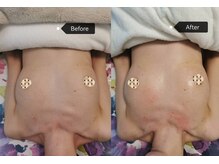 シークレット(Secret)/バストアップ