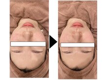 ラピス 新宿/サーマトリックス