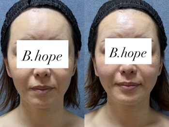 ビーホープ(B.hope)/40代モニター様の変化
