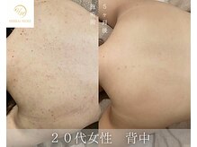 肌耕/背中のハーブピーリング