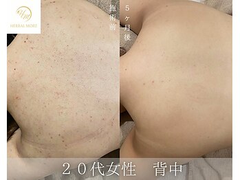 肌耕/背中のハーブピーリング