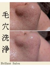 ブレリアントサロン 池袋店(brillant salon)/毛穴洗浄ビフォーアフター