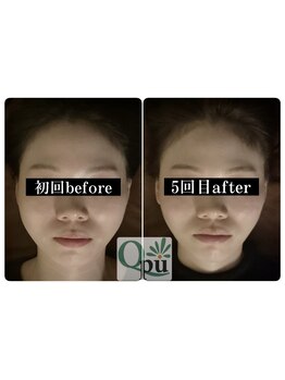 キュープ 小顔美容矯正専門サロン 横浜店(Qpu)の写真/食いしばりによるあごの疲れやエラ張りを整え、シャープなフェイスラインに！