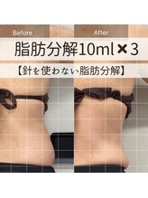 サンポ 神戸元町店(SANPO)/10ml×3回