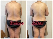 メリンダ(Merinda)/肩甲骨まわりの筋膜ケア