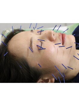 鍼灸施術を受けたい