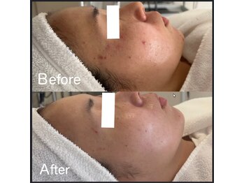 萬裡(マリン)/ワイコ水光ピールで・ニキビケア