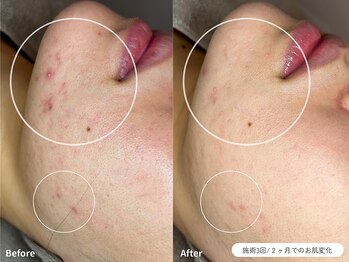 フォンビューティー(fon beauty)/ニキビケア×3回