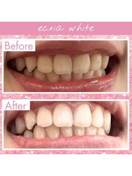 ルアナシンフォニア エクシア 池袋店(Luana-Sinfonia)/ホワイトニングビフォーアフター