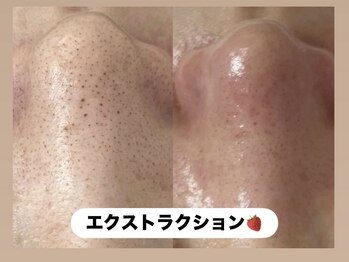 ラヴィ(Ravi)/毛穴エクストラクション