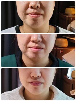 ラピスラズリ/【レモンボトル】ほうれい線3回