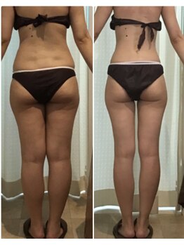 ダイヤモンドビューティー(Diamond Beauty)/最新超音波マシーンで最強痩身