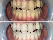 アーティ(aaty)/セルフホワイトニング/白い歯