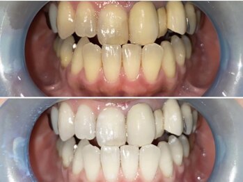 アーティ(aaty)/セルフホワイトニング/白い歯