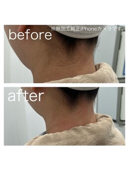 ラクシー 北千住(luxssy)/うなじ