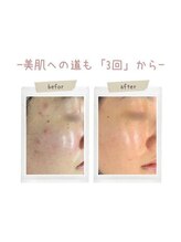 インディバケアプラチナム 横浜店/インディバ施術