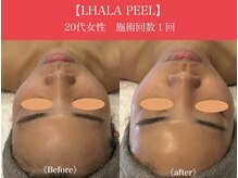 リプロ(RePro)/ララピール　ビフォーアフター