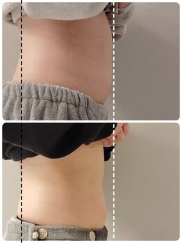 グランディールアン(GRANDIR UN)/やれば変わる脂肪冷却