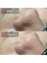 ミースリーズ(methrees)/1回でつるりん鼻♪ピカピカ毛穴