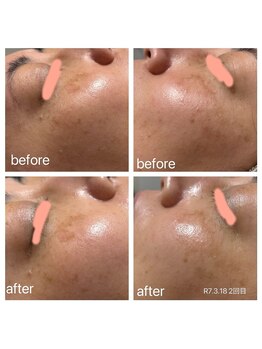 おうちサロンちか/ララピール