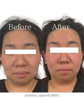 プランツ(PLANTS)/40代／１回／小顔
