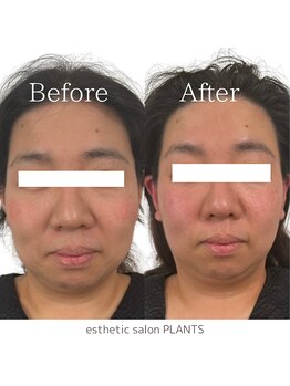 プランツ(PLANTS)/40代／１回／小顔