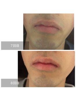 ダンニヒル(dannihil)/【ヒゲ脱毛+眉】20代学生8回目