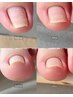 巻き爪補正1か所￥5500