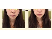 ルクラ(Lucura)/歪みケアでスッキリ小顔